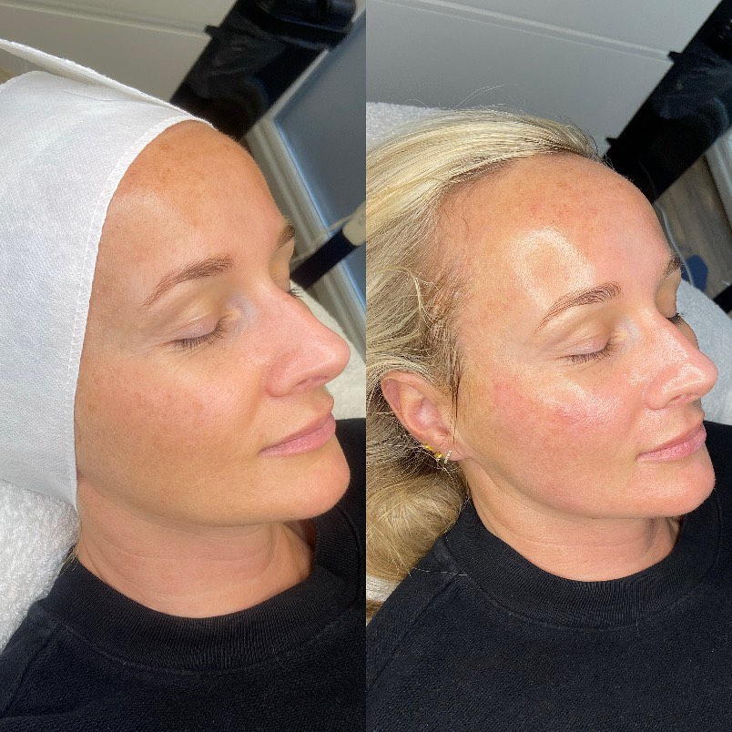 Ultimate Glow- Firming Facial with RF